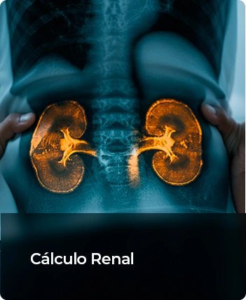 Calculo-renal-Dr.-Tulio-Leandro-Urologista.webp